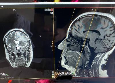 Врачи Саратовской городской клинической больницы номер 6 успешно провели две сложнейших операци на головном мозге